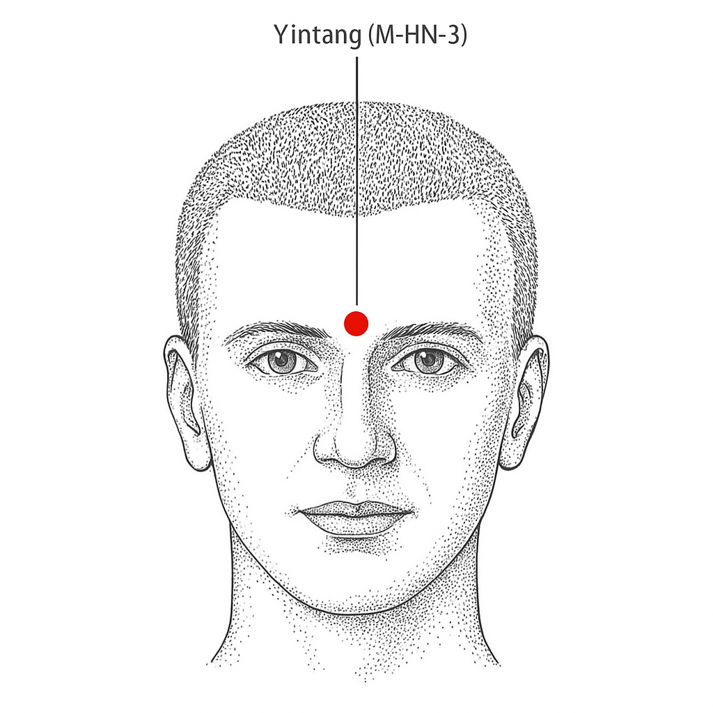 Akupunktur - Yintang